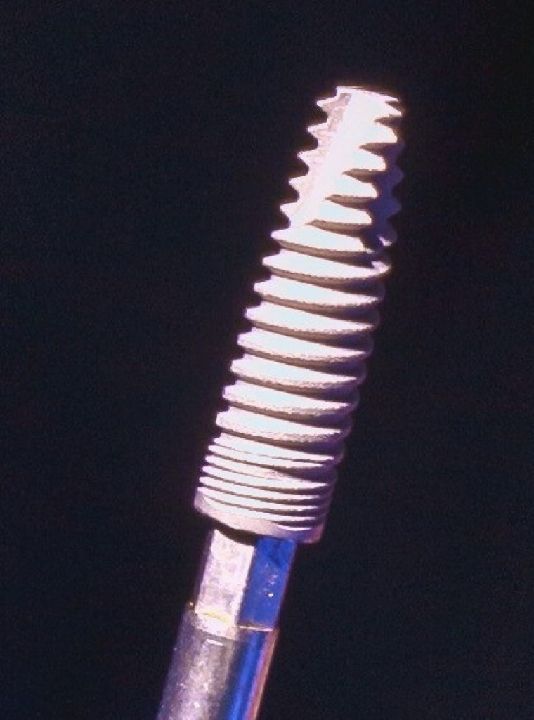 Zahnimplantat